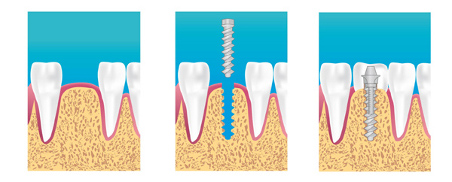 implant dentaire paris 14 eme